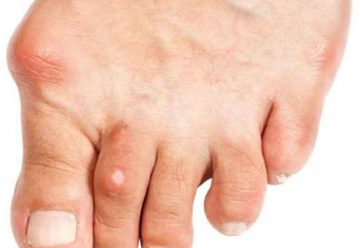 Ácido úrico, una enfermedad común en hombres Ácido úrico, una enfermedad común en hombres